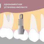 Имплантация зубов под ключ: стоматология Флоренция